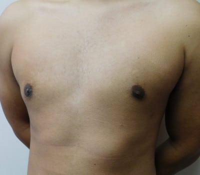 After Image: Gynecomastia - left-side