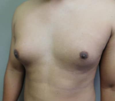 Before Image: Gynecomastia - left-side
