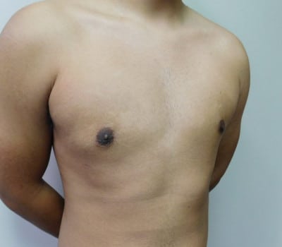 After Image: Gynecomastia - right-side