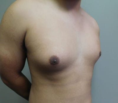 Before Image: Gynecomastia - right-side