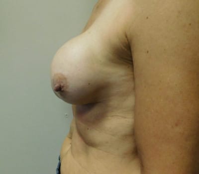 Before Image: Complex breast issues - other