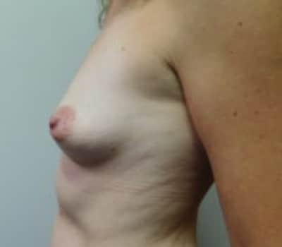 Before Image: Breast Augmentation - other