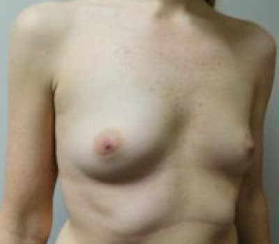 Before Image: Breast Augmentation - left-side