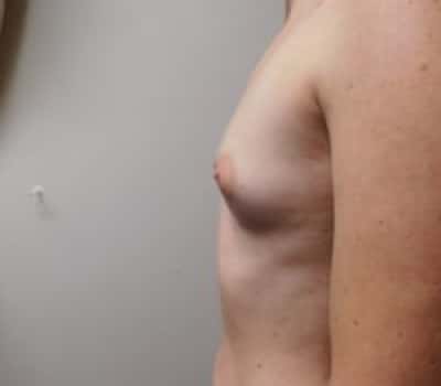 Before Image: Breast Augmentation - other