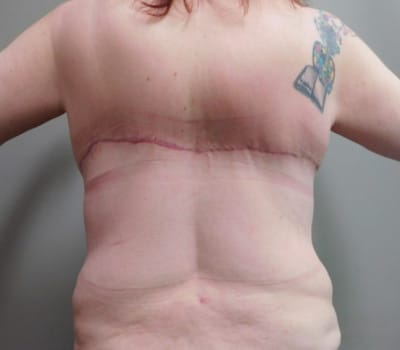 After Image: Back/Bra Lift - front