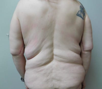 Before Image: Back/Bra Lift - front