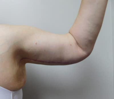 After Image: Brachioplasty - front