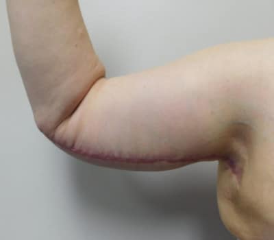 After Image: Brachioplasty - front