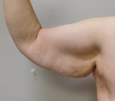 Before Image: Brachioplasty - front