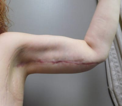 After Image: Brachioplasty - front