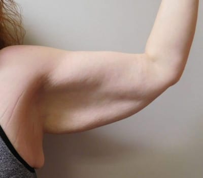 Before Image: Brachioplasty - front