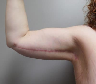 After Image: Brachioplasty - front