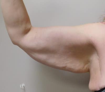 Before Image: Brachioplasty - front