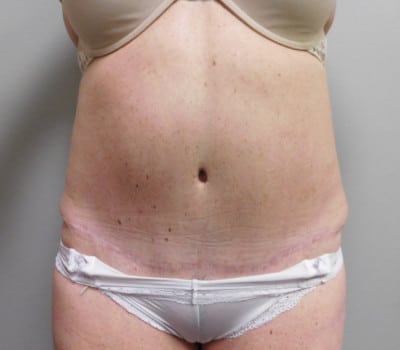 After Image: Abdominoplasty - front