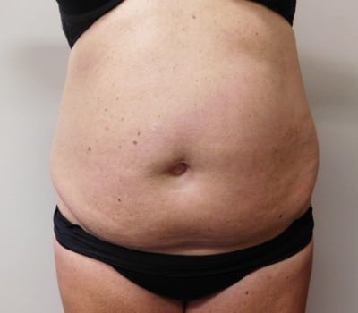 Before Image: Abdominoplasty - front