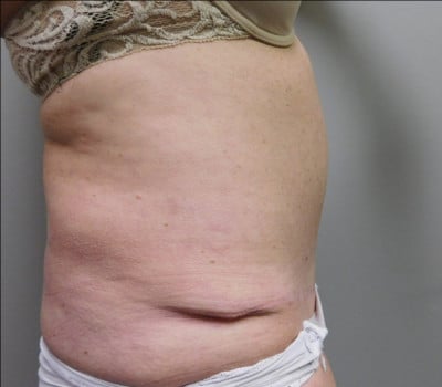After Image: Abdominoplasty - front