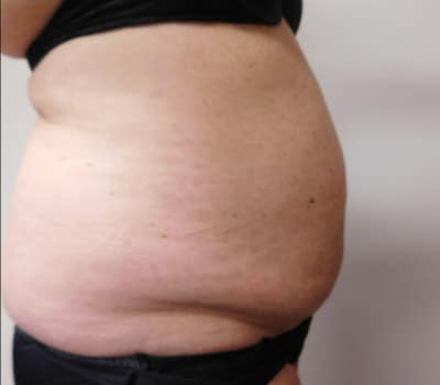 Before Image: Abdominoplasty - front