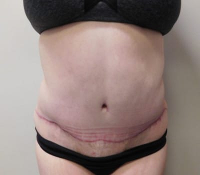 After Image: Abdominoplasty - front