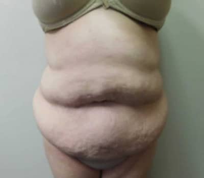Before Image: Abdominoplasty - front