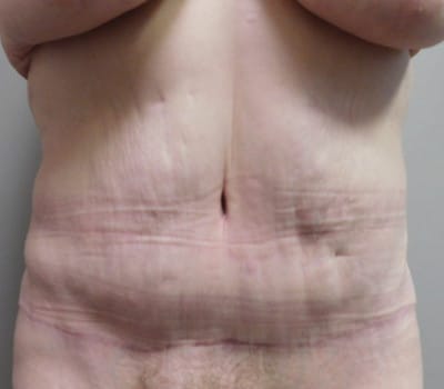 After Image: Abdominoplasty - front