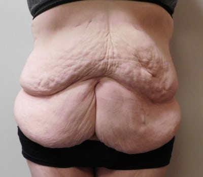 Before Image: Abdominoplasty - front