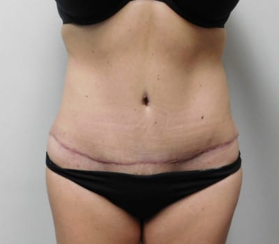 After Image: Abdominoplasty - front