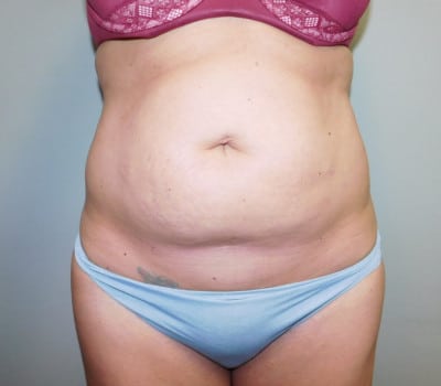 Before Image: Abdominoplasty - front