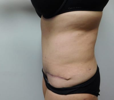 After Image: Abdominoplasty - other