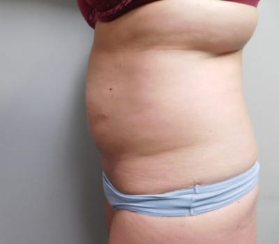 Before Image: Abdominoplasty - other