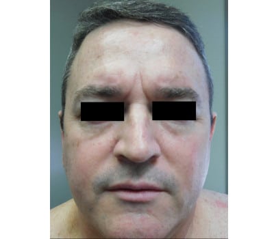 After Image: Fat Injection - front