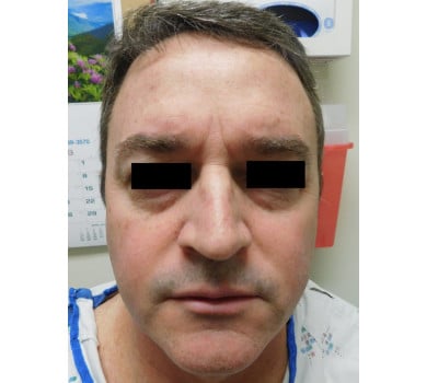 Before Image: Fat Injection - front
