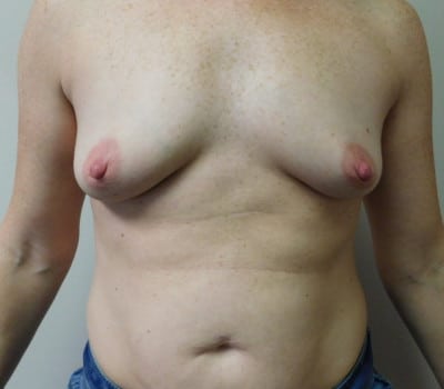 Before Image: Breast Augmentation - front
