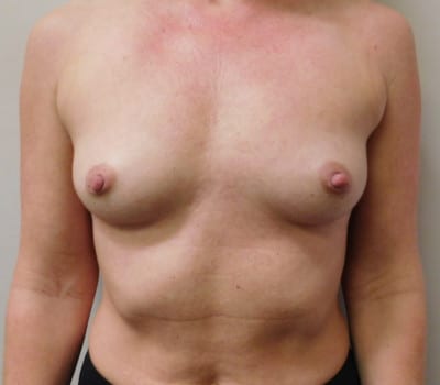 Before Image: Breast Augmentation - front
