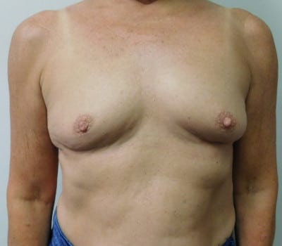 Before Image: Breast Augmentation - front