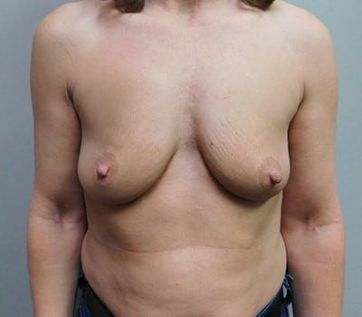Before Image: Breast Augmentation - front