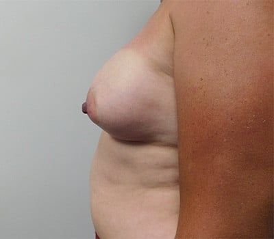 After Image: Breast Augmentation - left-side
