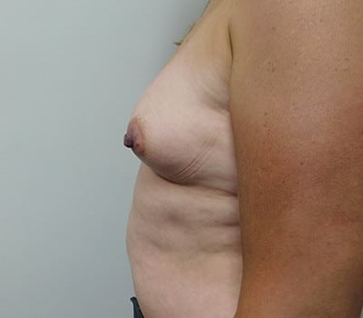 Before Image: Breast Augmentation - left-side