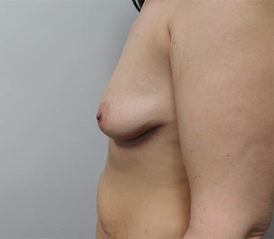 Before Image: Breast Augmentation with Lift - left-side