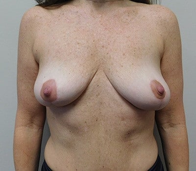 Complex Breast Issues