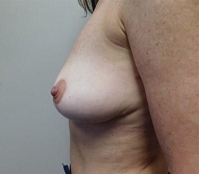 After Image: Complex Breast Issues - left-side
