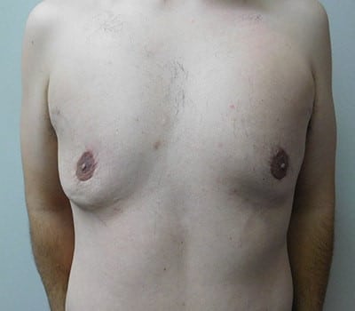 After Image: Gynecomastia - front