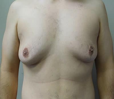 Before Image: Gynecomastia - front