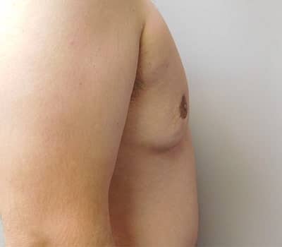 After Image: Gynecomastia - right-side