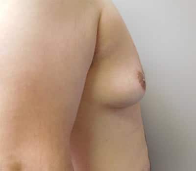 Before Image: Gynecomastia - right-side