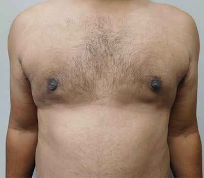 After Image: Gynecomastia - front