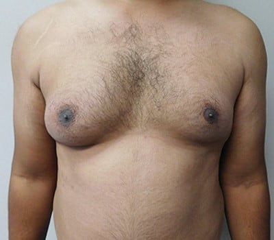 Before Image: Gynecomastia - front