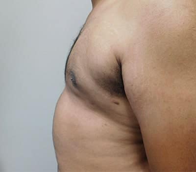 After Image: Gynecomastia - other