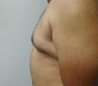 Before Image: Gynecomastia - other