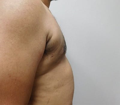 After Image: Gynecomastia - other