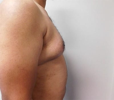 Before Image: Gynecomastia - other